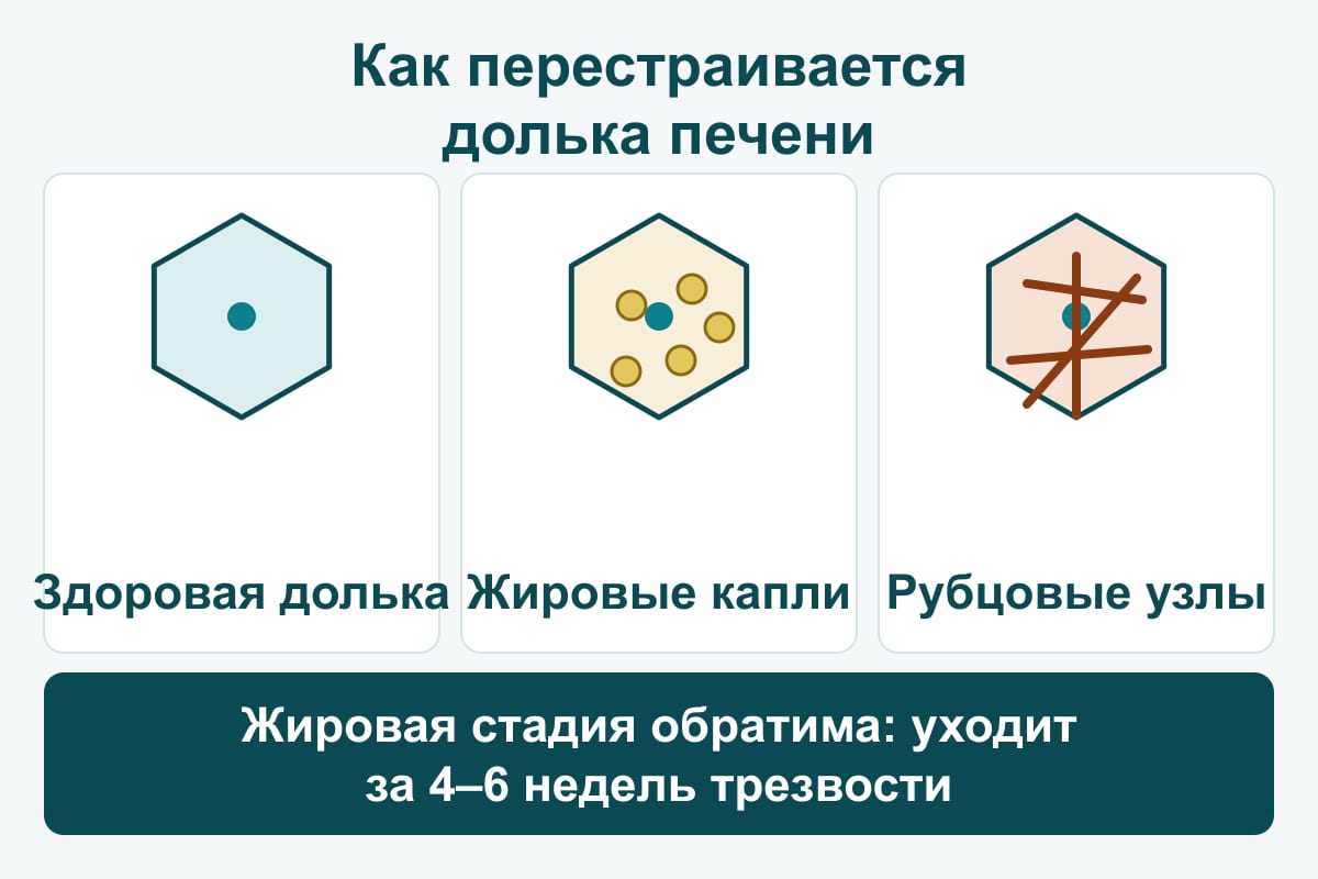 Схема: три дольки печени — здоровая, с жировыми каплями, разделённая рубцовыми перегородками на узлы